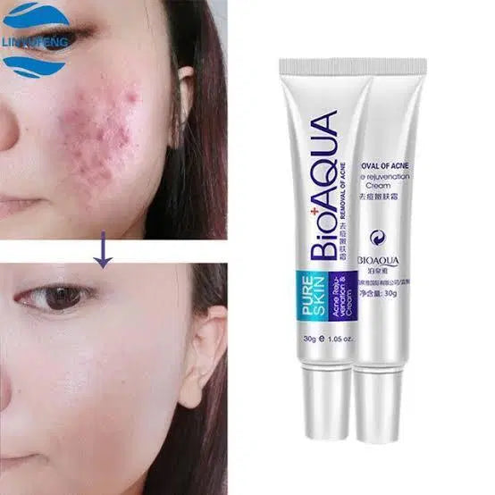 BIOAQUA-Acne Scar Removal Cream